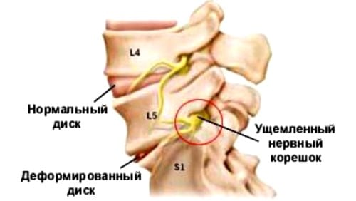 Остеохондроз позвоночника с корешковым синдромом в грудном отделах