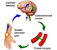 Каузалгия