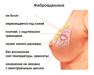 Код диагноза мкб мастопатия