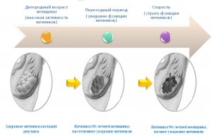 Изменения в яичниках