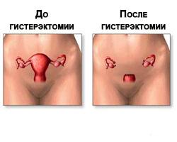 Постгистерэктомический синдром